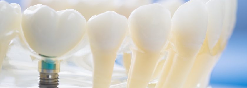 Materiales de los implantes dentales
