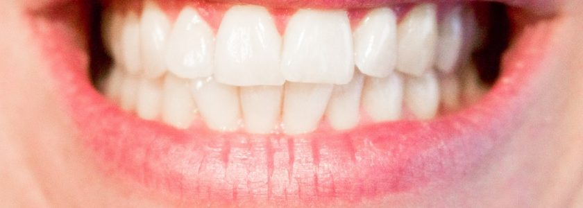 ¿Para qué sirven las sobredentaduras sobre implantes dentales?