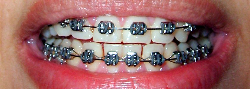 Diferencias entre los diversos tipos de ortodoncia.