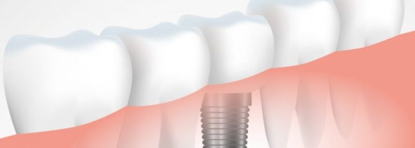 Postoperatorio de los implantes dentales