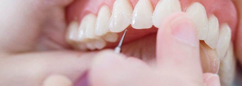 Mitos sobre las prótesis dentales