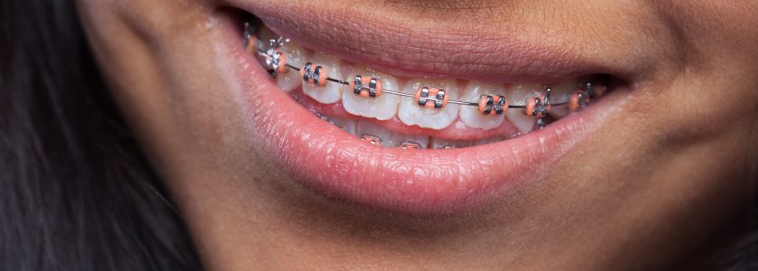 Tratamientos de ortodoncia: ¿qué son y en qué casos son necesarios?